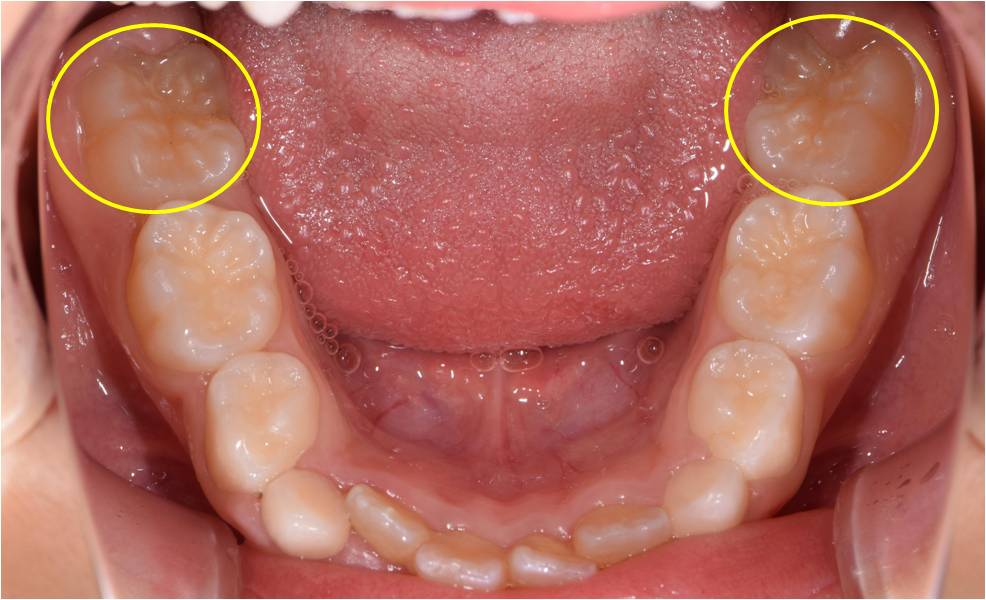 ６歳臼歯について　その①