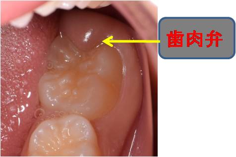 ６歳臼歯について　その②