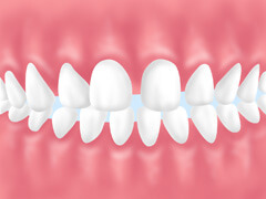 空隙歯列（すきっ歯）