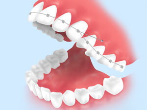 歯科矯正用アンカースクリューを用いた矯正歯科治療