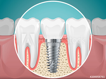 インプラント治療は土台となる歯周の健康が大切です
